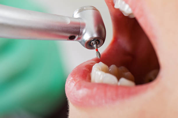 Best Emergency Root Canal Treatment in Yamhill, OR